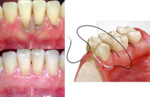 Periodontal Treatment