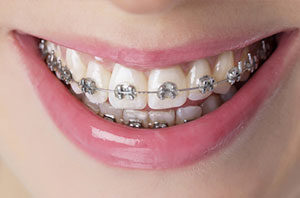 FIXED braces