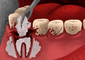 tooth grafting