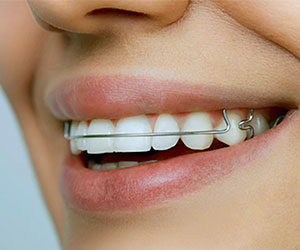 removable braces