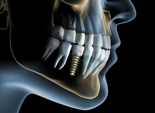 Dental Implants