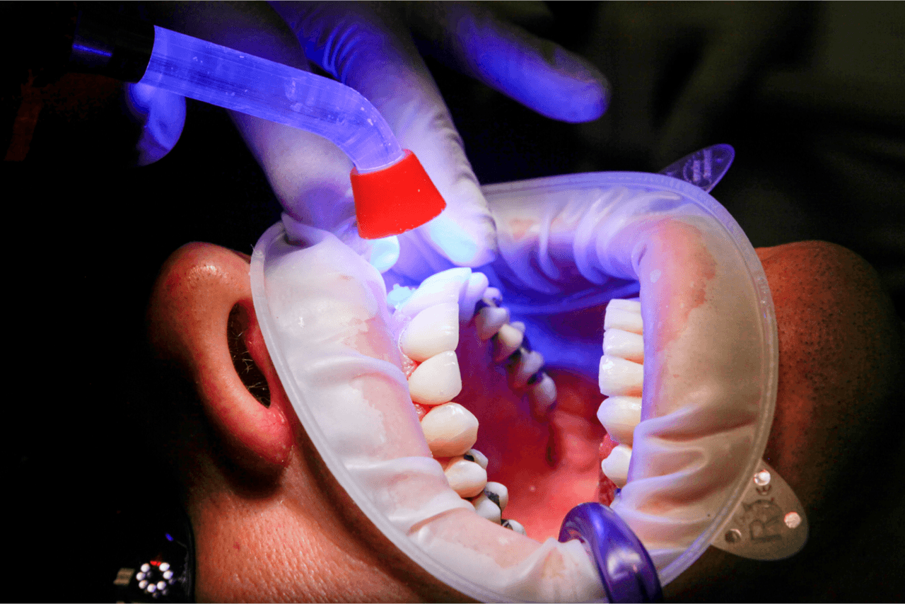 Laser Dental treatment