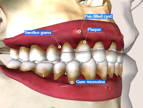 Periodontitis